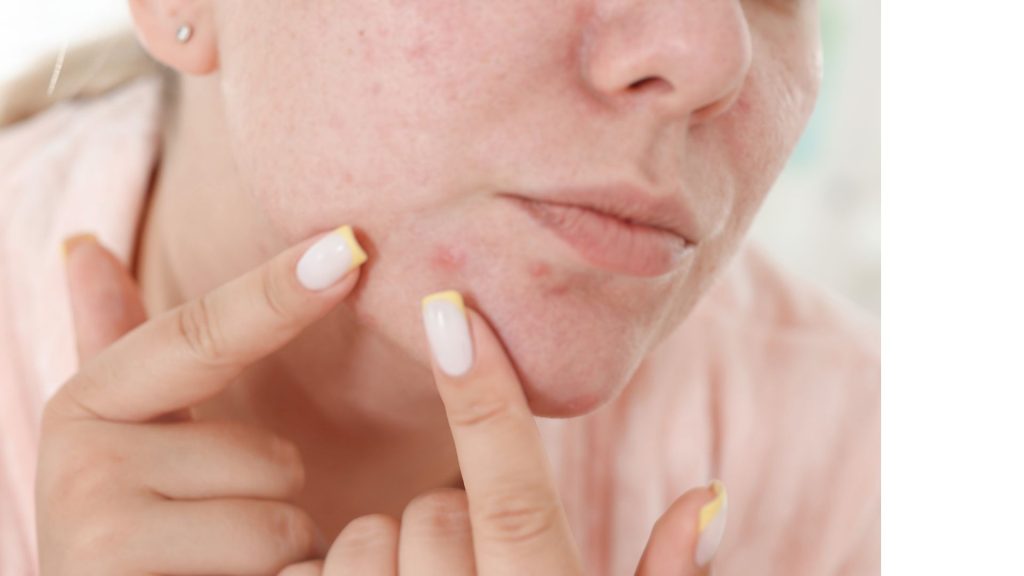 Hormonal acne on jawline in woman over 40 showing hormone imbalance skin changes